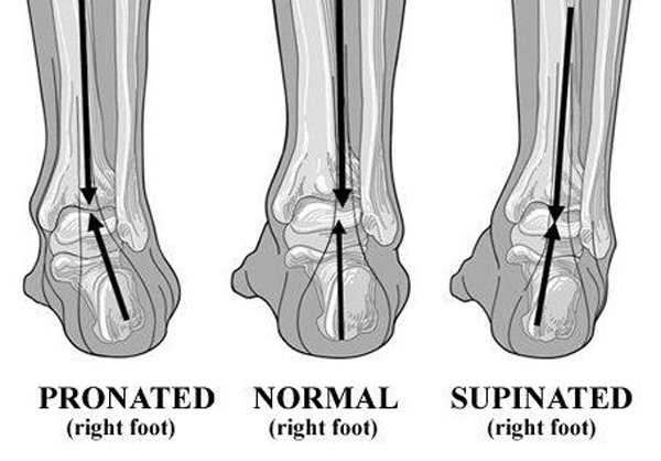 PronationFoot